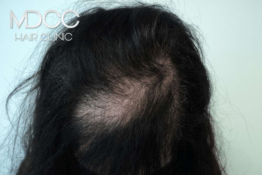 This image has an empty alt attribute; its file name is tricopigmentation-avant-1024x683-1.png